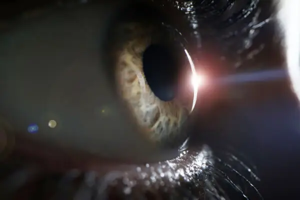 Femtosekunden-Laser assistierte Grauer Star-/Katarakt-Operation
